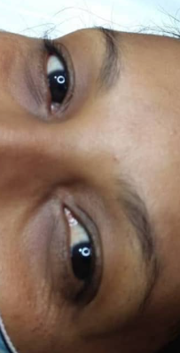 Antes do procedimento 2
